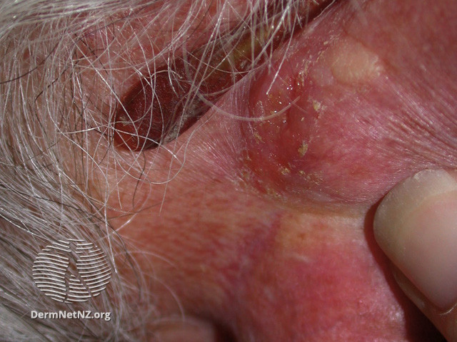 File:Intraepidermal carcinoma (DermNet NZ lesions-scc-in-situ-2961).jpg
