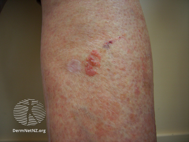 Intraepidermal carcinoma (DermNet NZ lesions-scc-in-situ-2963).jpg
