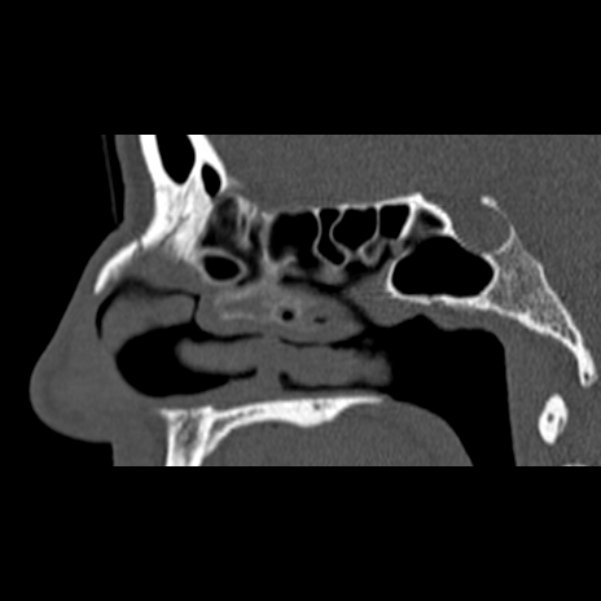 Nasal septal perforation (Radiopaedia 25030-25289 Sagittal bone window 24).jpg