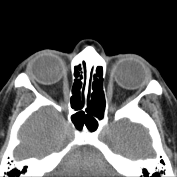 Nasolabial cyst (Radiopaedia 33987-35205 Axial non-contrast 34).jpg
