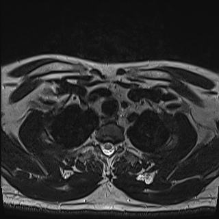 Nasopharyngeal carcinoma with perineural spread (Radiopaedia 55030-61380 Axial T2 86).jpg