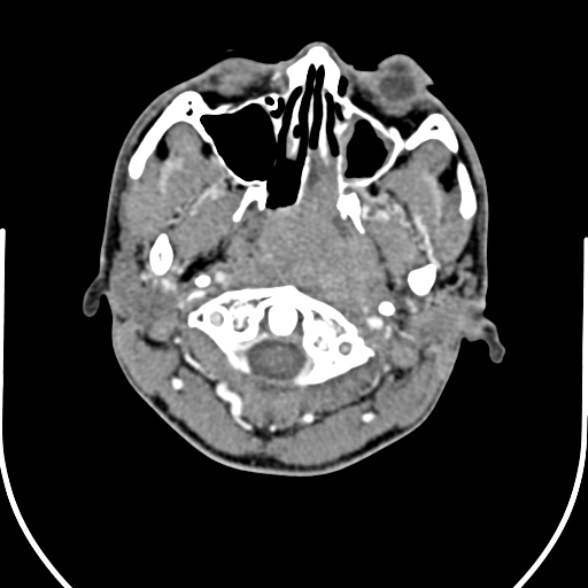 Nasopharyngeal carcinoma with skull base invasion (Radiopaedia 53415-59705 A 44).jpg