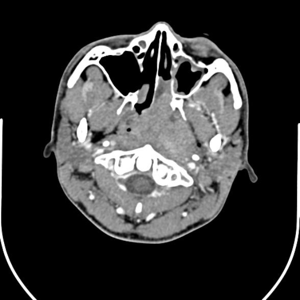 File:Nasopharyngeal carcinoma with skull base invasion (Radiopaedia 53415-59705 A 48).jpg