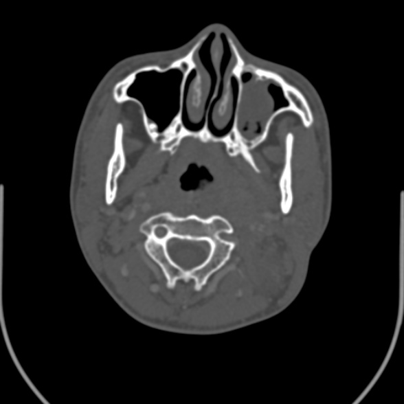 Nasopharyngeal carcinoma with skull base invasion (Radiopaedia 53415-59705 Axial bone window 66).jpg