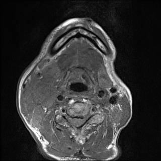 File:Nasopharyngeal carcinoma with skull base invasion (Radiopaedia 59258-66600 B 46).jpg