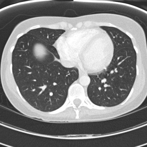 File:Necrobiotic pulmonary nodules - Crohn disease (Radiopaedia 20723-20631 Axial lung window 101).jpg
