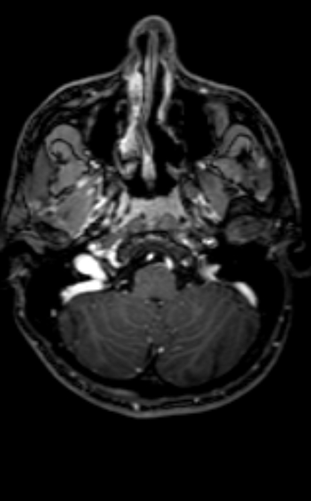 Neuro-Behçet disease (Radiopaedia 90112-107294 Axial T1 C+ 182).jpg
