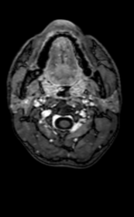 Neuro-Behçet disease (Radiopaedia 90112-107294 Axial T1 C+ 226).jpg
