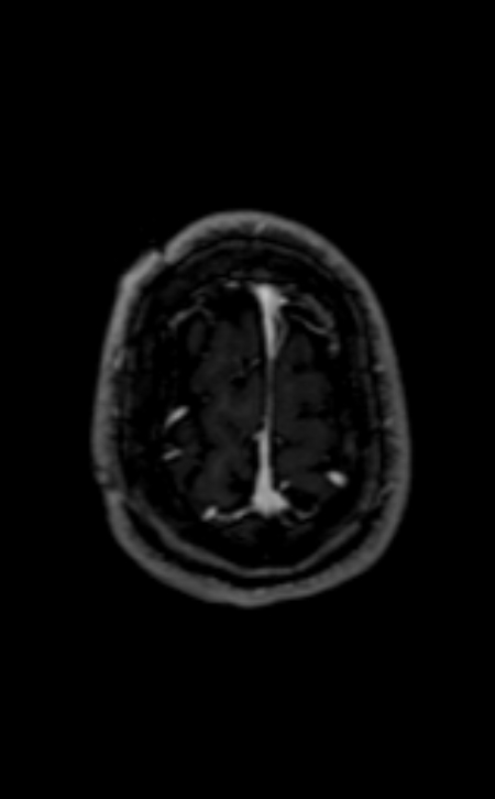 Neuro-Behçet disease (Radiopaedia 90112-107294 Axial T1 C+ 59).jpg