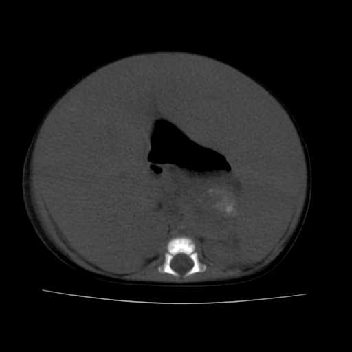 File:Neuroblastoma (Radiopaedia 20876-20799 Axial non-contrast 12).jpg