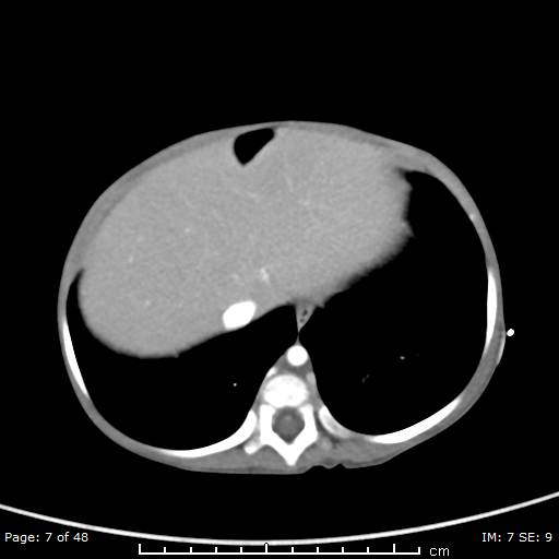 File:Neuroblastoma (Radiopaedia 41472-44355 A 7).jpg