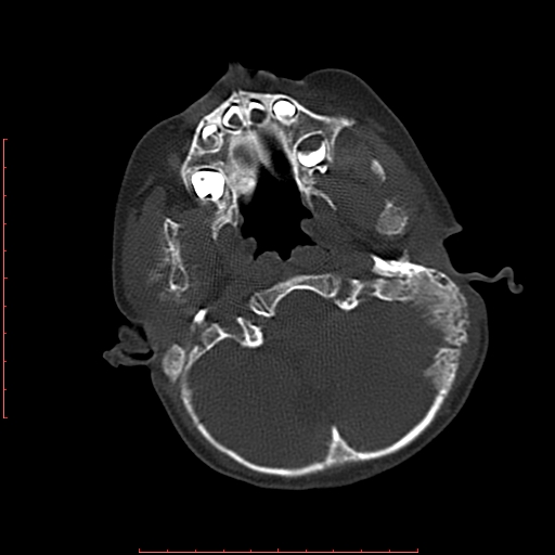 File:Neuroblastoma skull metastasis (Radiopaedia 56053-62683 Axial bone window 5).jpg
