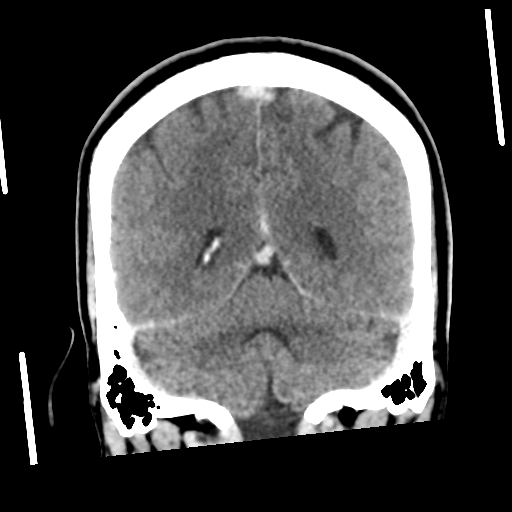 Neurocysticercosis - granular nodular (Radiopaedia 42786-45957 Coronal C+ 46).png
