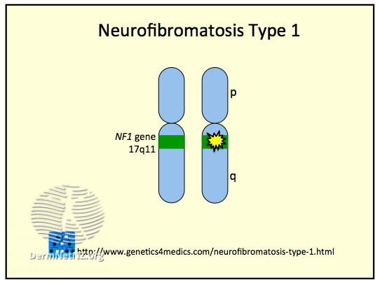 File:Neurofibromatosis Type 1 (DermNet NZ Neurofibromatosis-Type-1).png