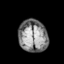 File:Neurofibromatosis type 1 (Radiopaedia 30089-30671 Axial FLAIR 21).jpg
