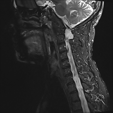 File:Neurofibromatosis type 1 (Radiopaedia 80355-93740 Sagittal STIR 3).jpg