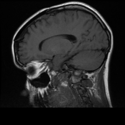 File:Neurofibromatosis type 2 (Radiopaedia 45229-49244 Sagittal T1 13).png