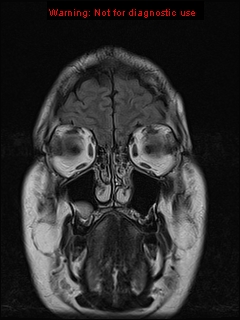 File:Neuroglial cyst (Radiopaedia 10713-11184 Coronal FLAIR 22).jpg