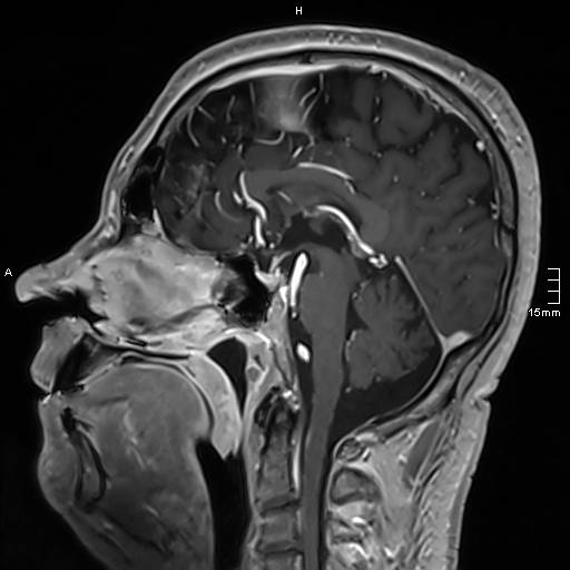 Neurosarcoidosis - involvement of the mesial temporal lobes (Radiopaedia 67429-76820 Sagittal T1 C+ 85).jpg