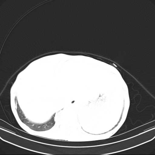 File:Non hodgkin lymphoma of the mediastinum (Radiopaedia 20814-20729 Axial lung window 50).jpg