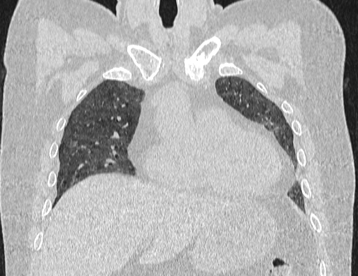 Non specific interstitial pneumonia (NSIP) (Radiopaedia 89725-106798 Coronal lung window 27).jpg