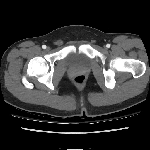 File:Normal CT angiogram of pelvis (Radiopaedia 45390-49430 A 50).jpg
