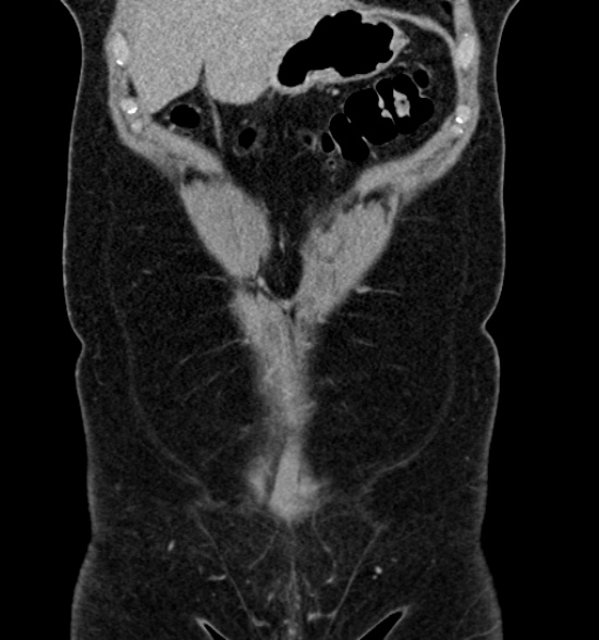 Normal CT intravenous urogram (Radiopaedia 39444-41759 A 183).jpg