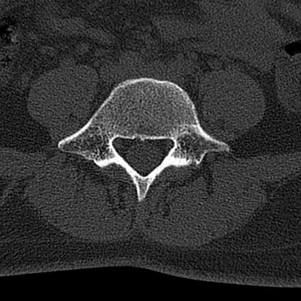 File:Normal CT lumbar spine (Radiopaedia 53981-60118 Axial bone window 56).jpg