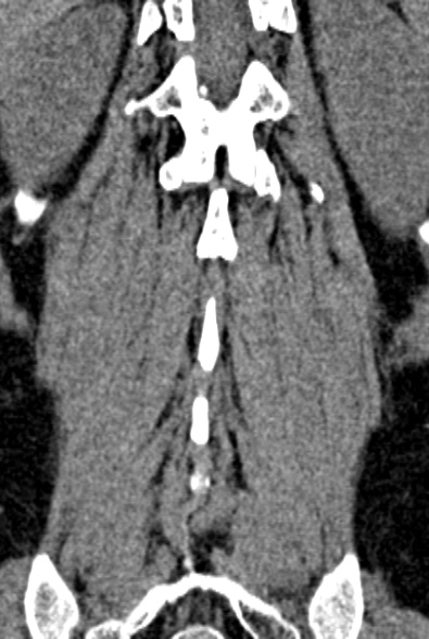 Normal CT lumbar spine (Radiopaedia 53981-60118 F 80).jpg