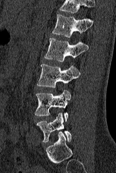 File:Normal CT lumbar spine (Radiopaedia 53981-60118 Sagittal bone window 65).jpg