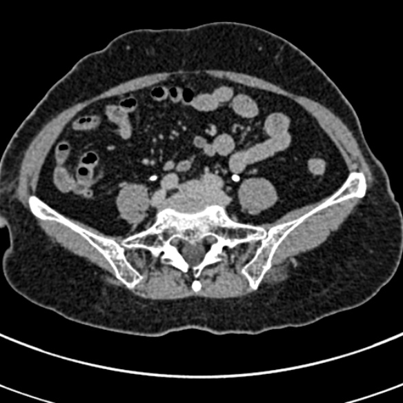 File:Normal CT split bolus study of the renal tract (Radiopaedia 48631-53634 Axial split bolus 195).jpg
