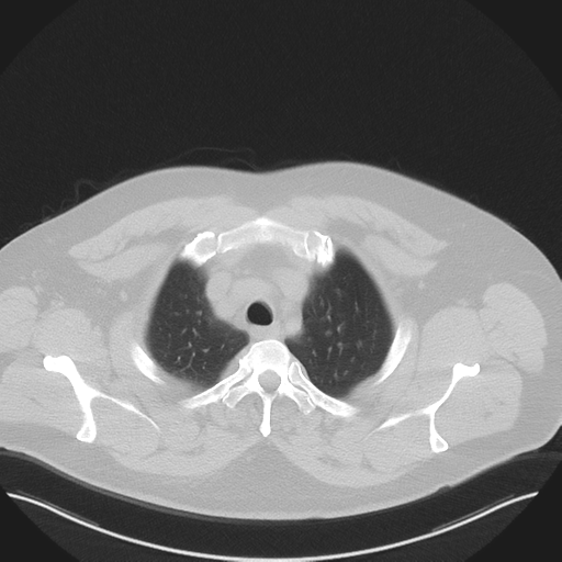 Normal HRCT (Radiopaedia 40797-43458 Axial lung window 10).png