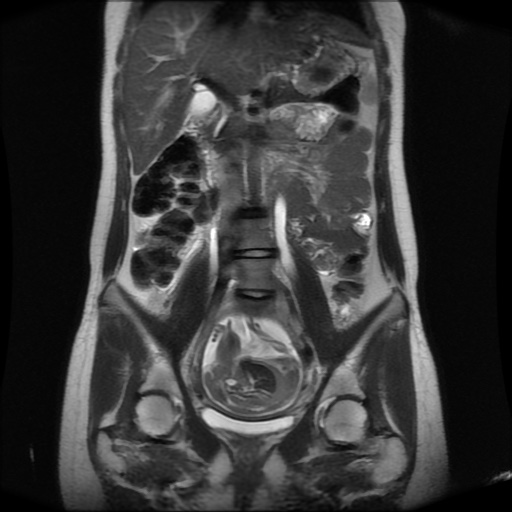 File:Normal MRI abdomen in pregnancy (Radiopaedia 88001-104541 Coronal T2 17).jpg