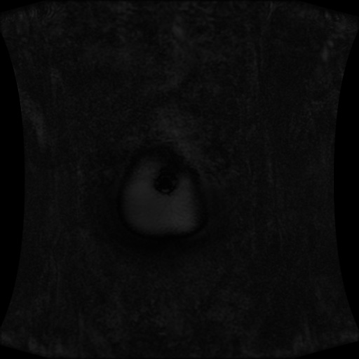 Normal MRI abdomen in pregnancy (Radiopaedia 88001-104541 N 8).jpg
