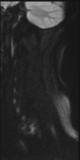 File:Normal MRI cervical spine (infection protocol) (Radiopaedia 53916-60039 Sagittal DWI 30).png