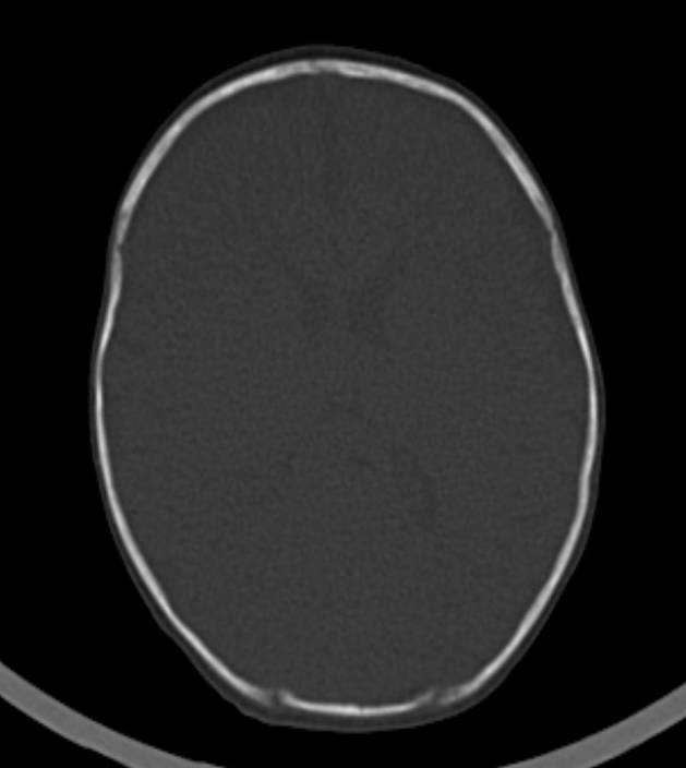 Normal brain CT - 2-month-old (Radiopaedia 53369-59350 Axial bone window 26).jpg