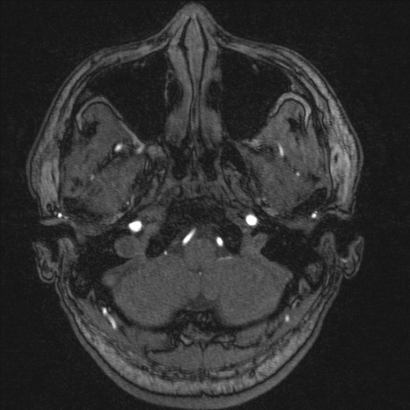 Normal brain MRI including MRA (Radiopaedia 48748-53763 Axial MRA 18).jpg