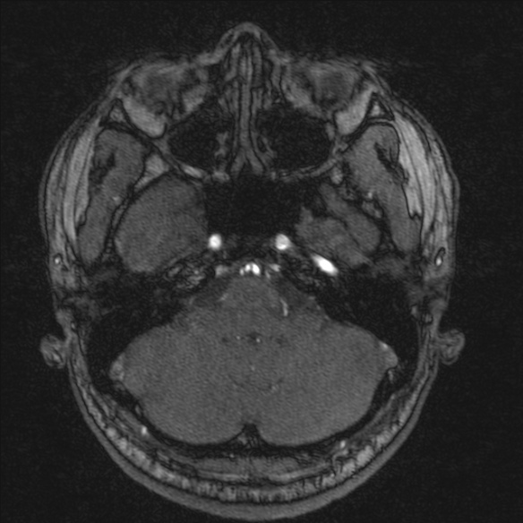 Normal brain MRI including MRA (Radiopaedia 48748-53763 Axial MRA 39).jpg