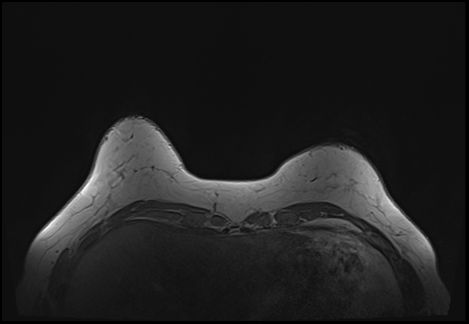 File:Normal breast MRI - dense breasts (Radiopaedia 80454-93850 Axial T1 35).jpg