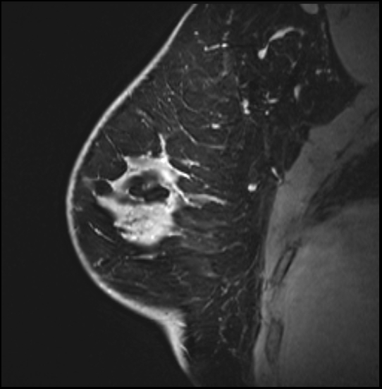 Normal breast MRI - dense breasts (Radiopaedia 80454-93850 I 56).jpg