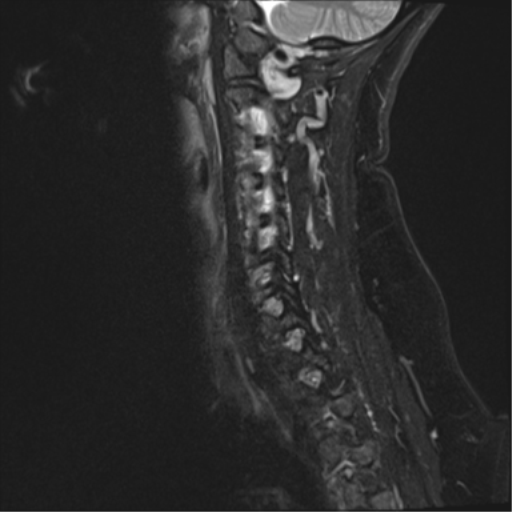 File:Normal cervical spine MRI (including Dixon) (Radiopaedia 42762-45925 Dixon- Water 4).png