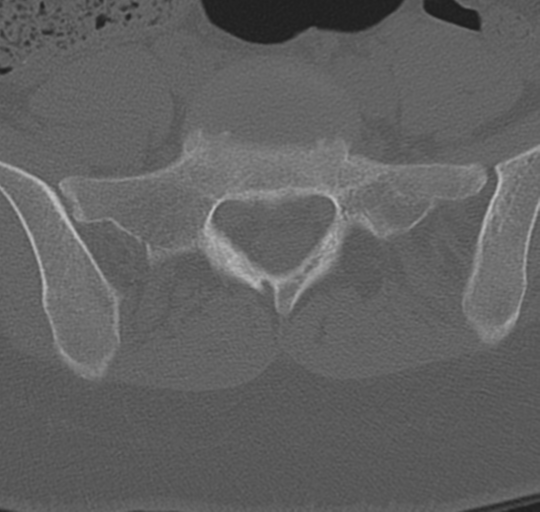 File:Normal lumbosacral CT (Radiopaedia 37923-39867 Axial bone window 81).png