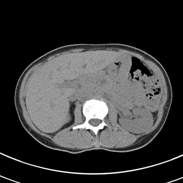 File:Normal multiphase CT liver (Radiopaedia 38026-39996 Axial non-contrast 27).jpg