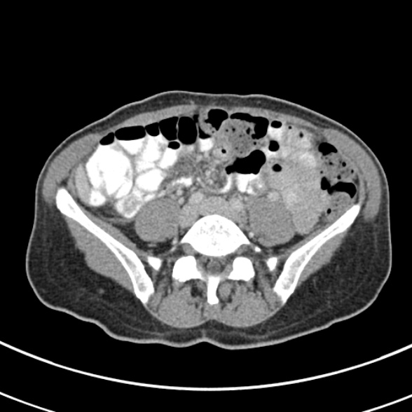 File:Normal multiphase CT liver (Radiopaedia 38026-39996 C 59).jpg
