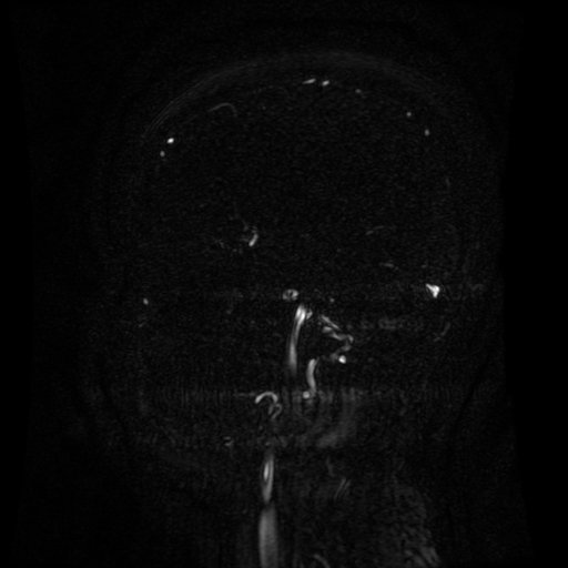 Normal noncontrast MR venography (Radiopaedia 87578-103957 A 117).jpg