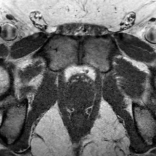 File:Normal prostate (MRI) (Radiopaedia 29986-30535 Axial T1 4).jpg
