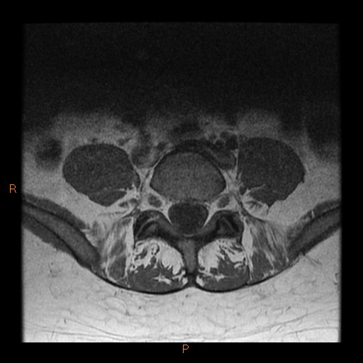 File:Normal spine MRI (Radiopaedia 77323-89408 Axial T1 21).jpg