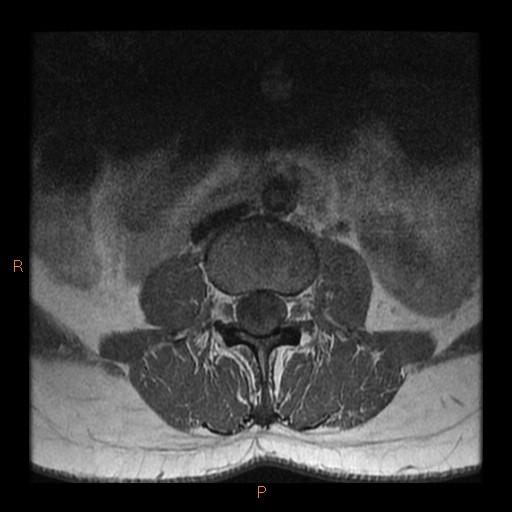 File:Normal spine MRI (Radiopaedia 77323-89408 Axial T1 5).jpg