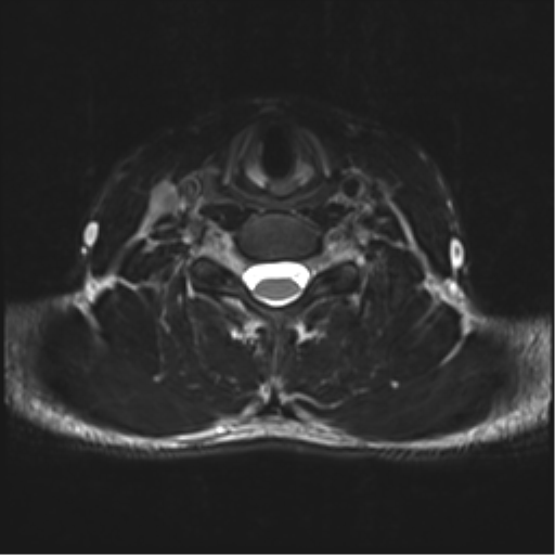 Normal trauma cervical spine (Radiopaedia 41017-43762 D 37).png