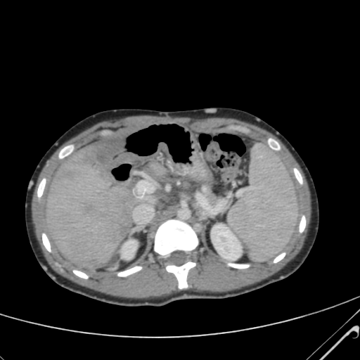 File:Nutmeg liver- Budd-Chiari syndrome (Radiopaedia 46234-50635 B 20).png